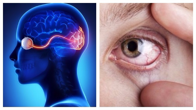 Воспаление зрительного нерва