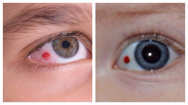 красные точки у детей в глазах