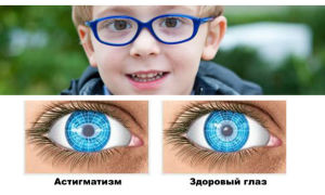 Амблиопия у детей зарядка
