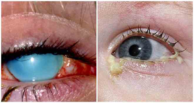 глазные болезни