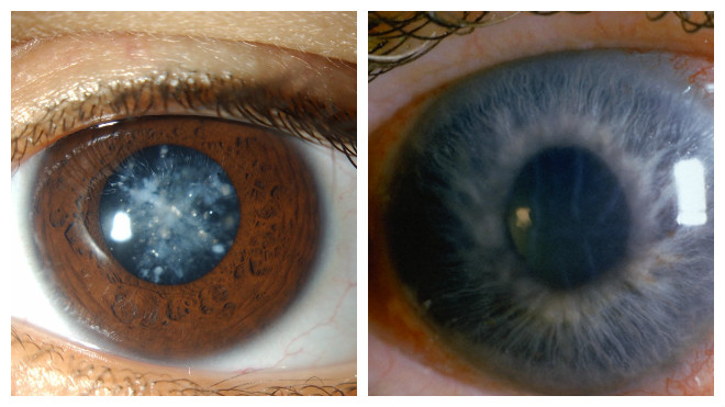 Глаукомы и катаракта