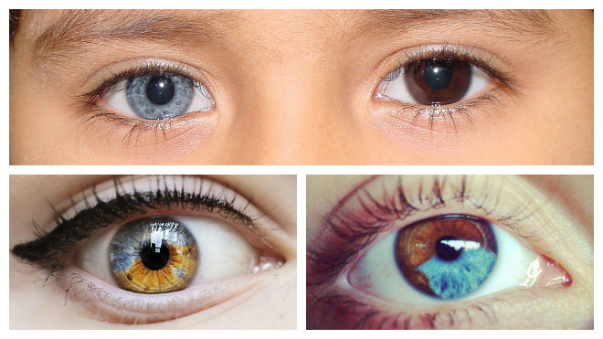 гетерохромия глаз