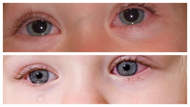 красные глаза у ребенка