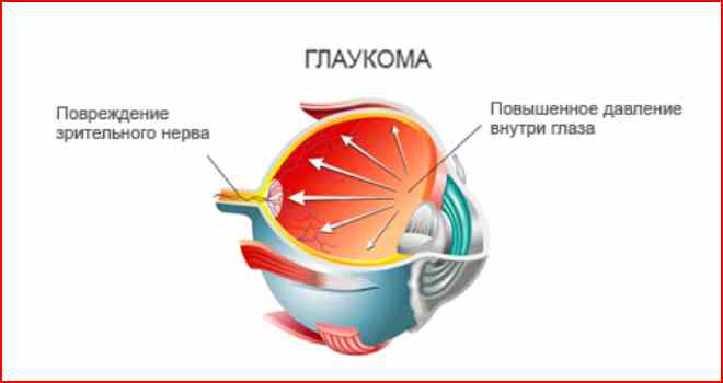 глаукома схема