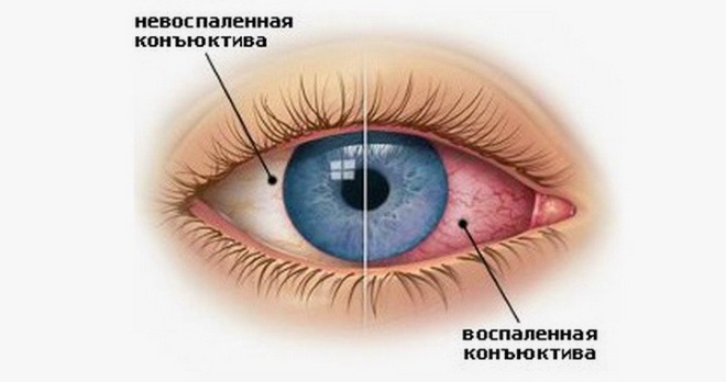 конъюнктивит - покраснение глаз