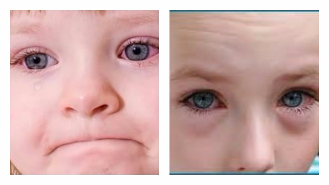 Как промывать глаза у детей