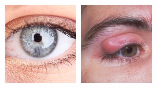 профилактика жировиков на глазах