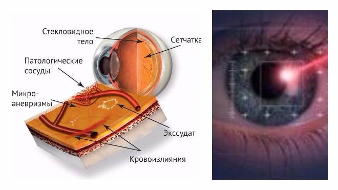После укрепления сетчатки. Фокальная лазерная коагуляция сетчатки глаза. Отграничительная лазеркоагуляция сетчатки глаз. Отслойка сетчатки лазерная коагуляция. Периферическая лазеркоагуляция сетчатки глаза.