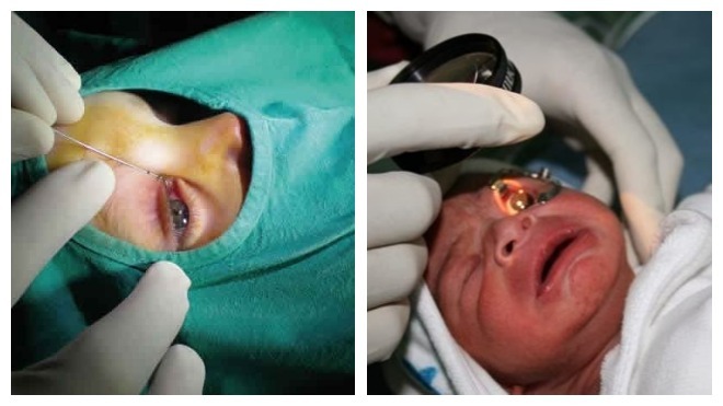 операция на глаза у детей