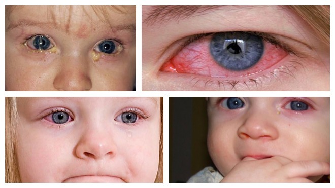 вирусный коньюктивит глаз у детей
