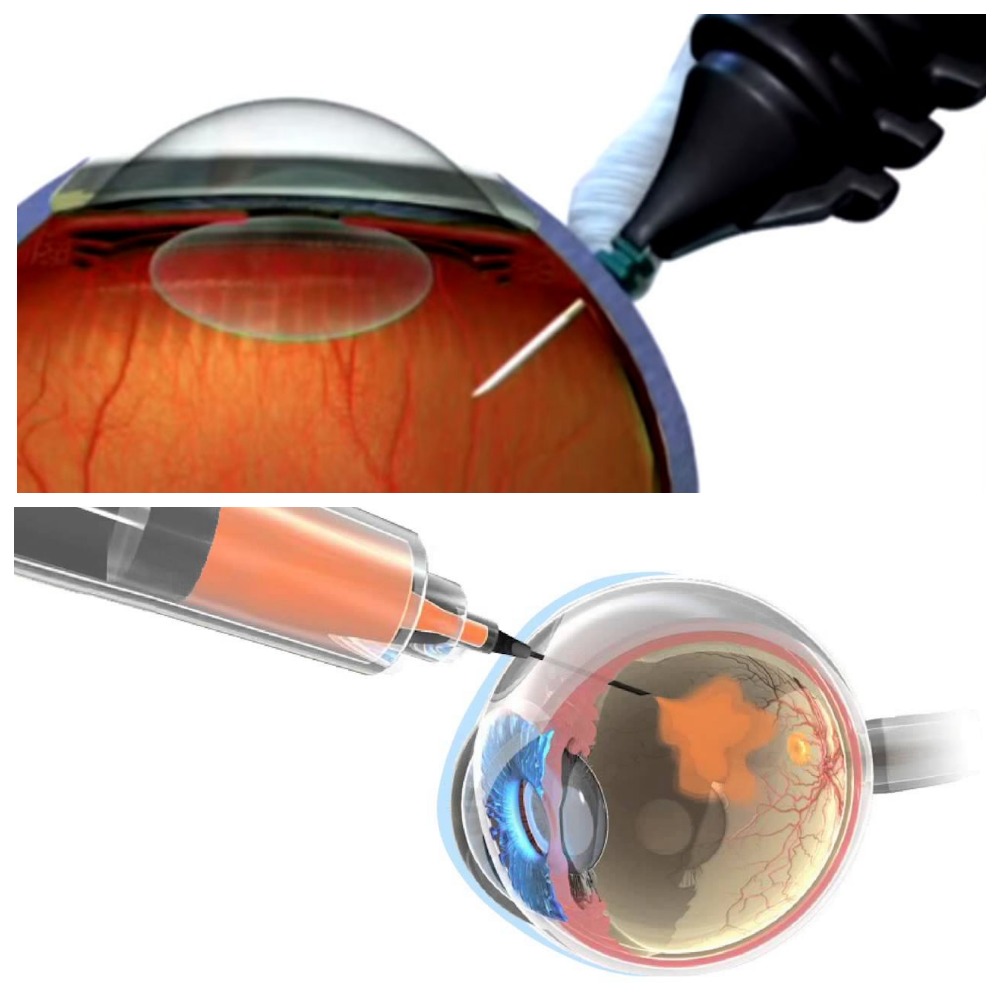 Разрыв сетчатки глаза и его лечение
