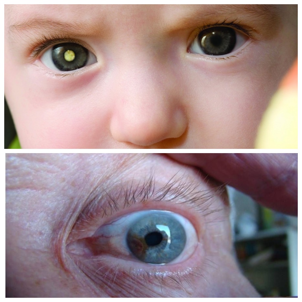 Классификация рака глаза и признаки его появления