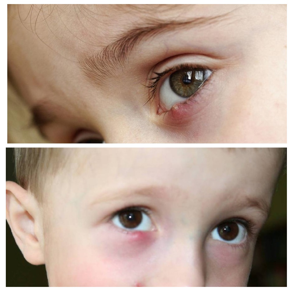 Ячмень на глазу у ребёнка - как лечить советы доктора Комаровского