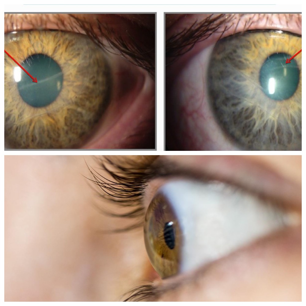 Что делать при постановке диагноза - открытоугольная глаукома