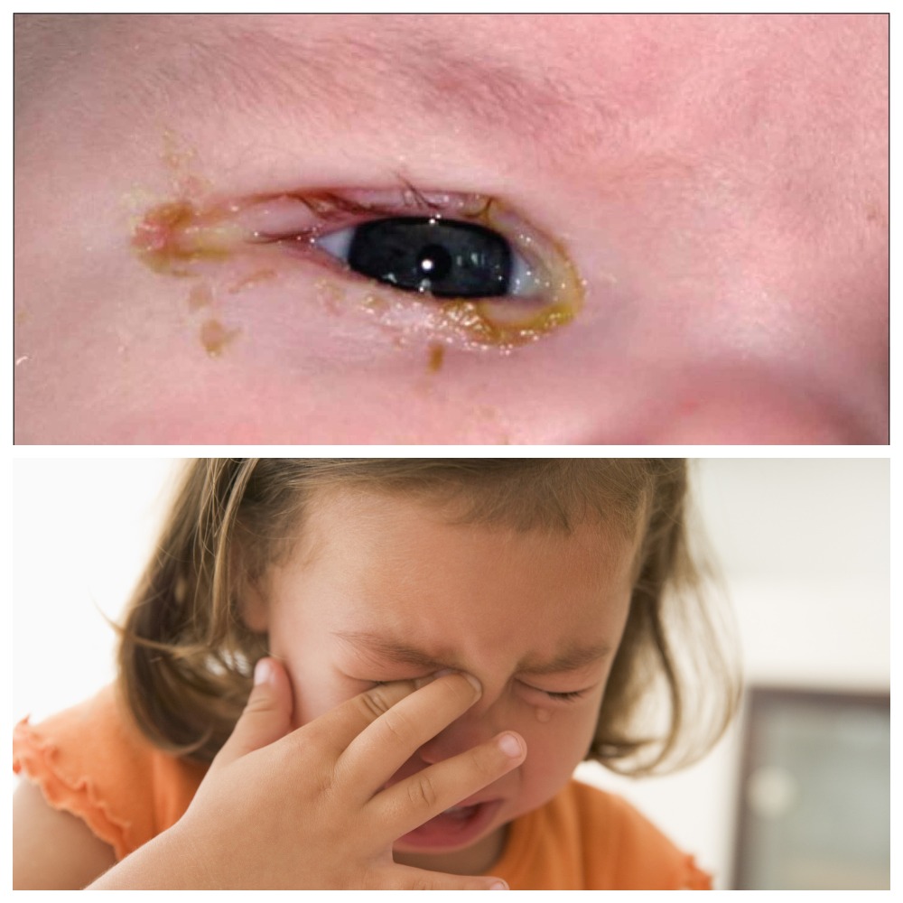Разбираемся, чем можно промывать глаза при конъюнктивите у детей