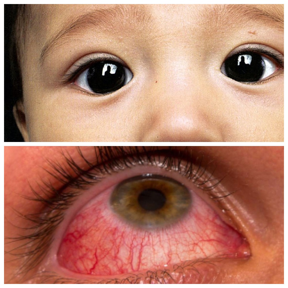 Перечень основных заболеваний глаз у детей и методы лечения