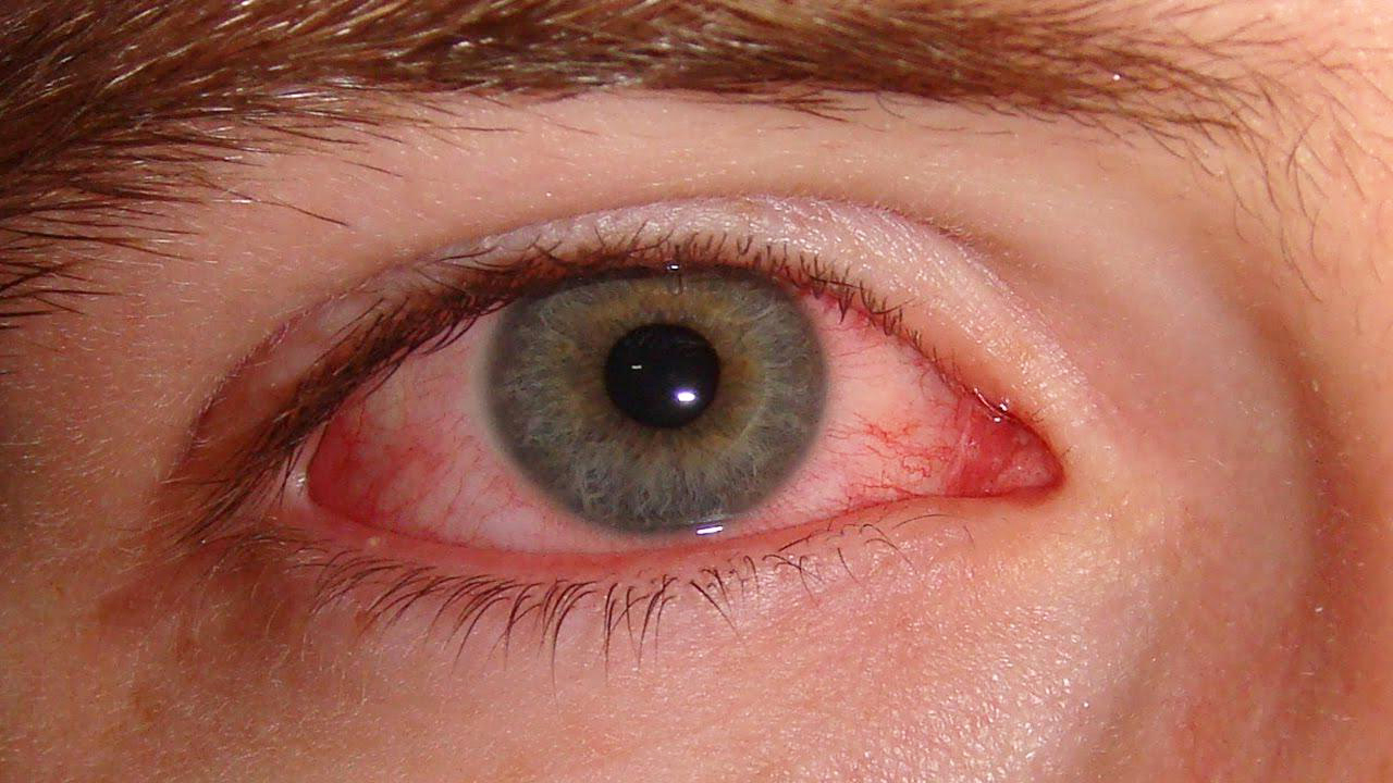 Заболевания сетчатки глаз