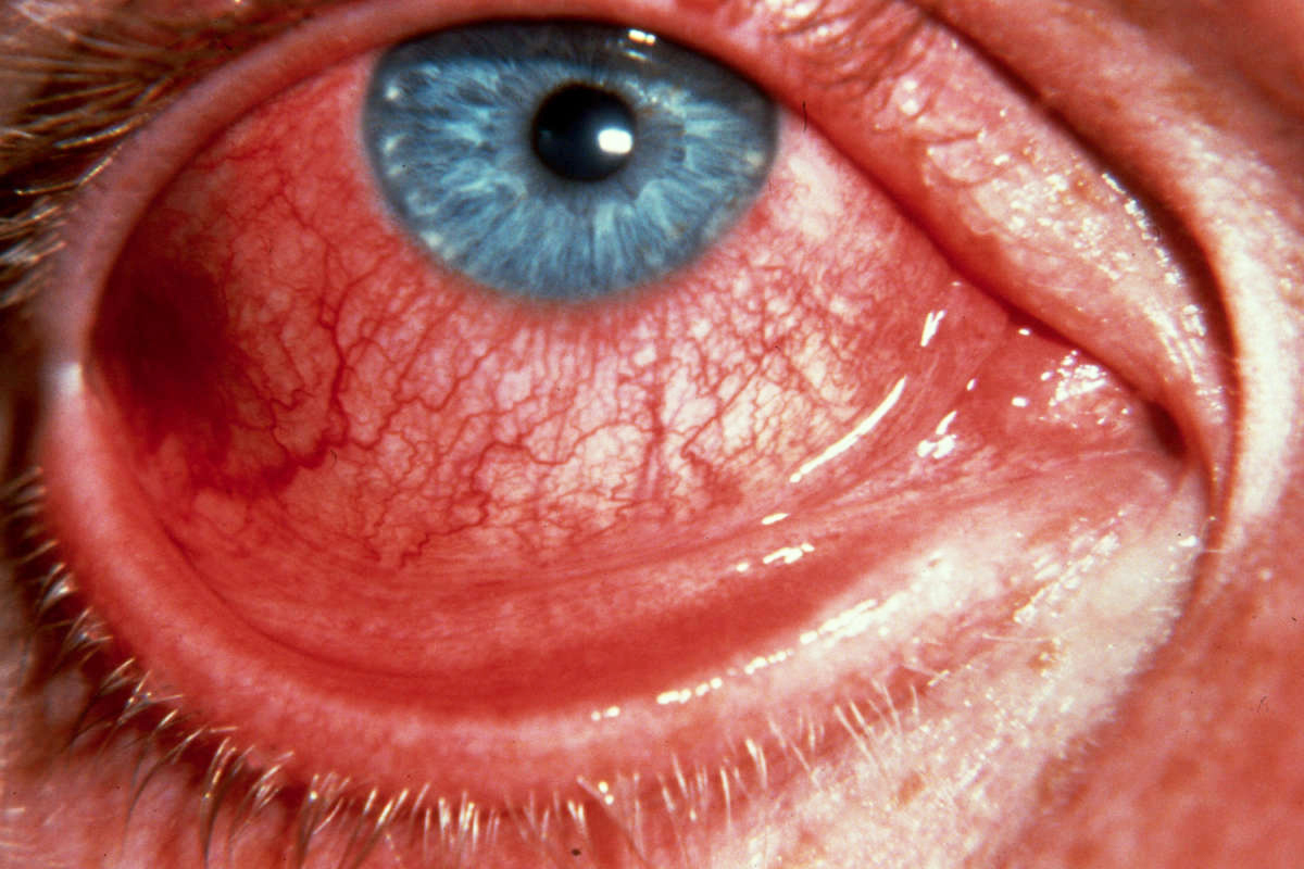 Чем опасны заболевания глаз