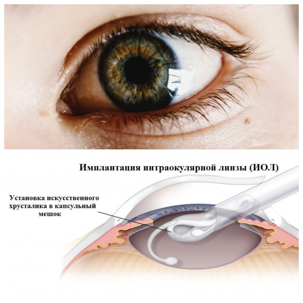 Операция на хрусталик глаза