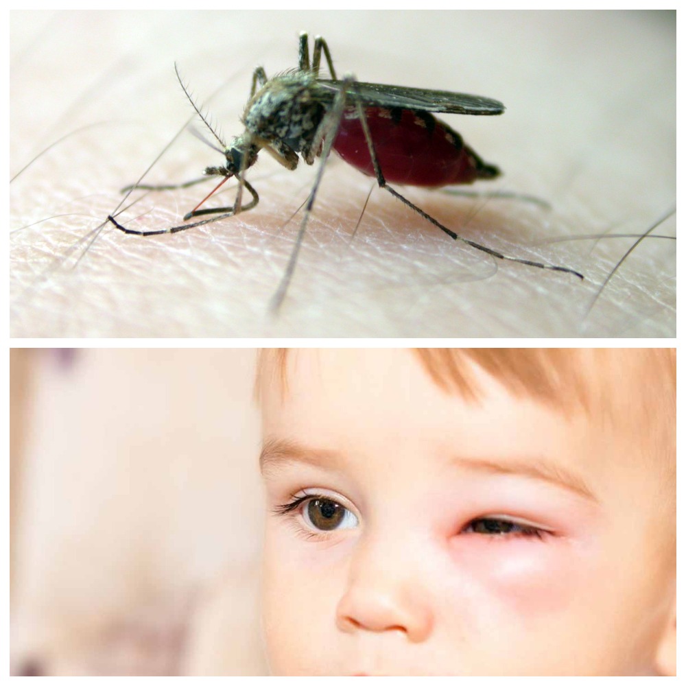 Что делать, если комар укусил в веко, как снять отек