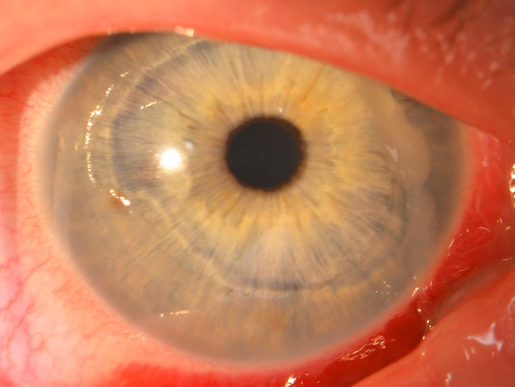 Заболевание роговицы глаза