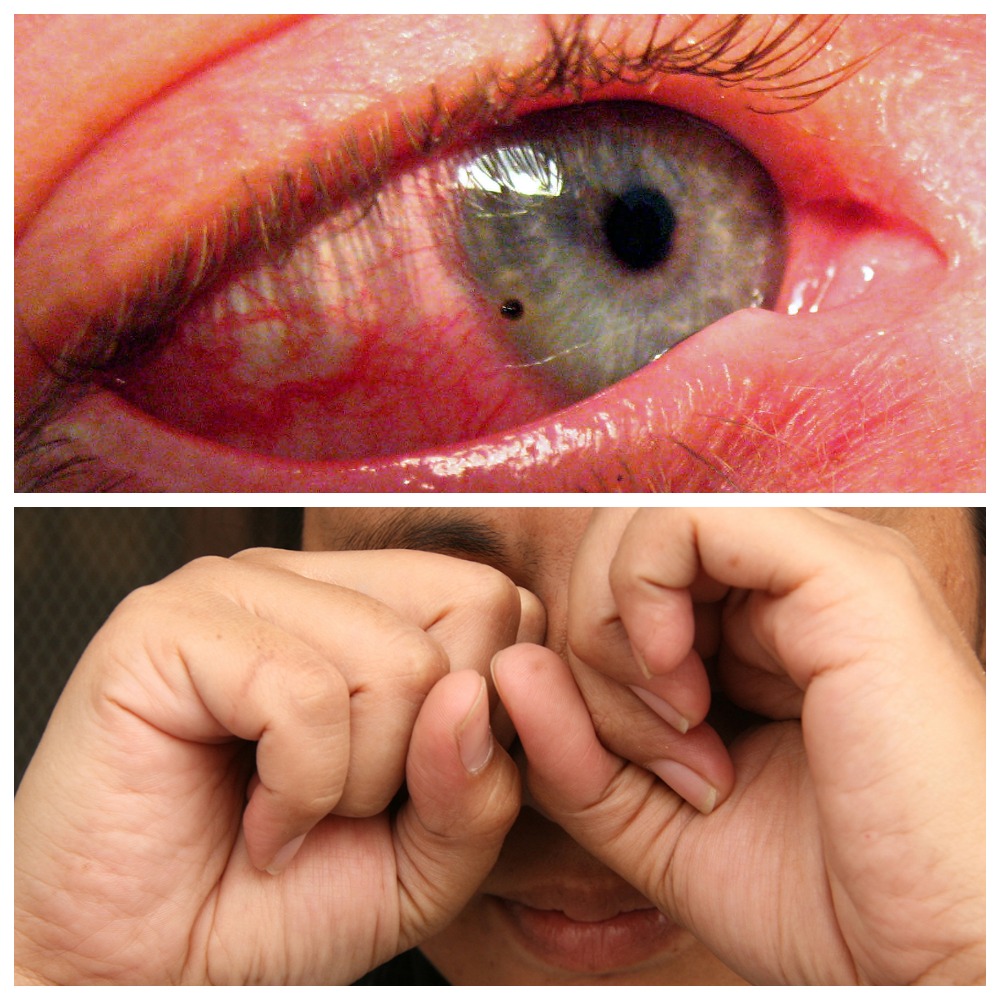 Царапина на роговице глаза - лечение воспаления