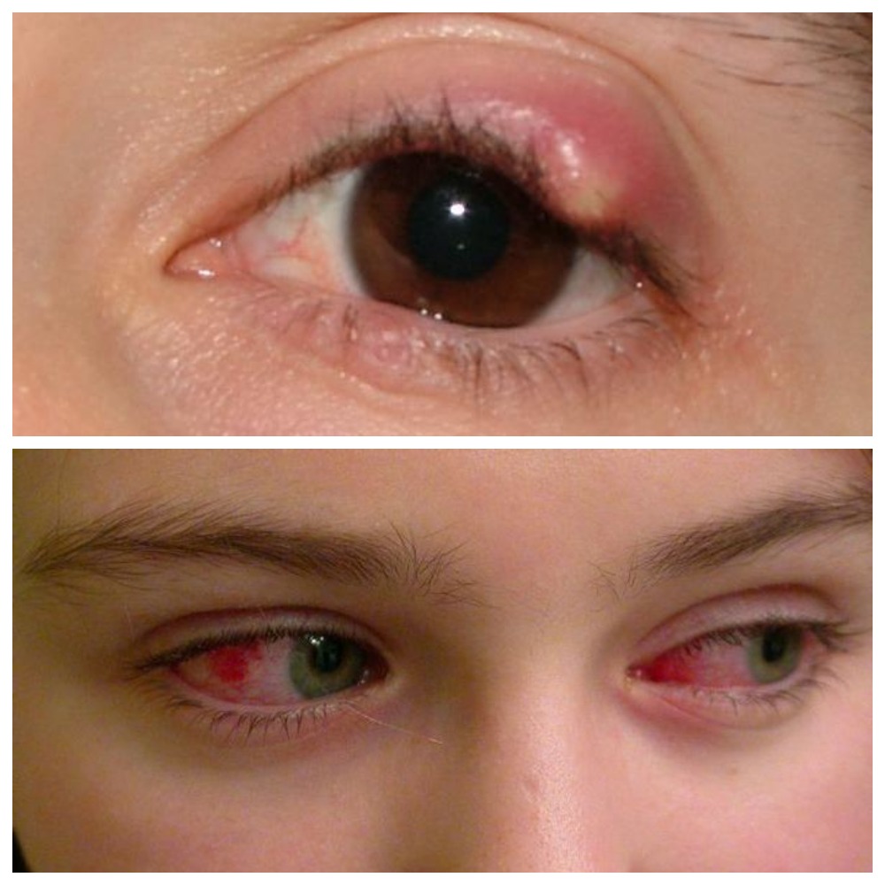 Инфекции глаз