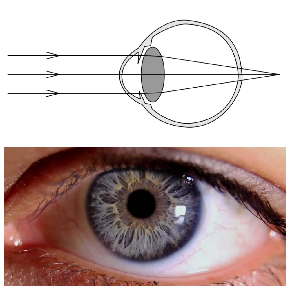 Аномалии рефракции глаза