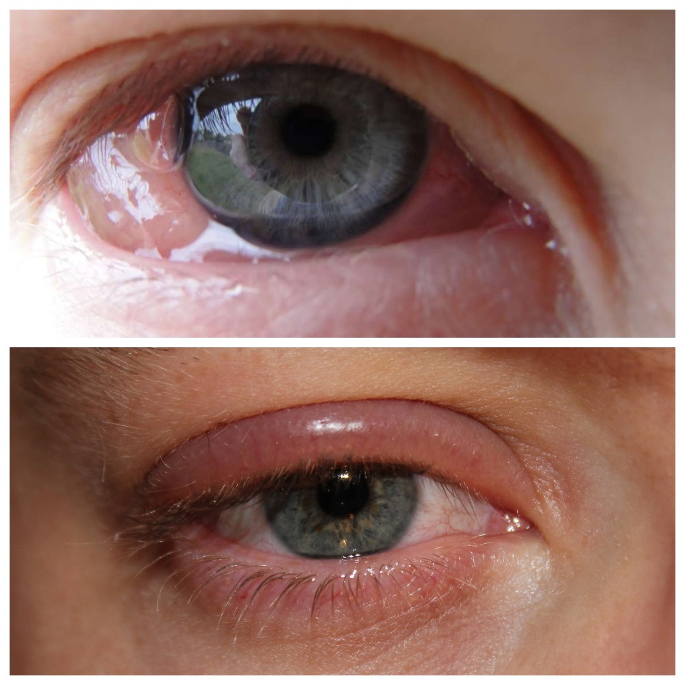 Виды и лечение инфекций глаз