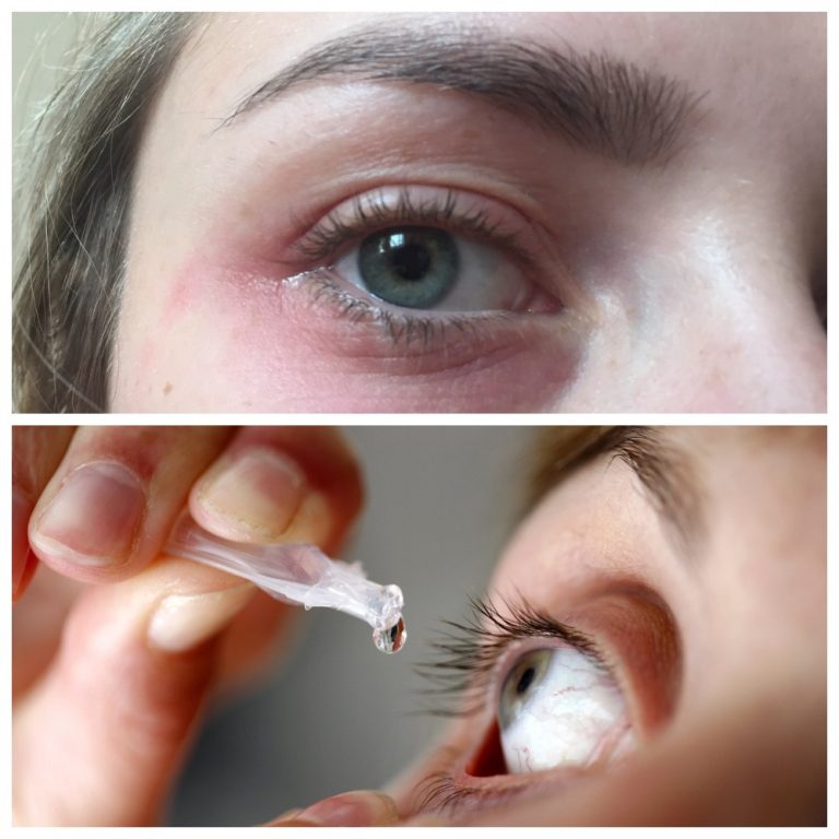 Грибок глаз — чем опасно заболевание Глаза и их заболевания