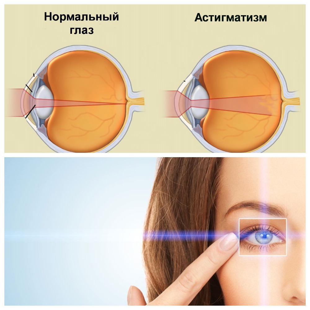 Можно носить линзы с очками. Смешанный гиперметропический астигматизм. Астигматизм роговицы глаза. Линзы -6.5 астигматизм. Зрение -5 астигматизм.