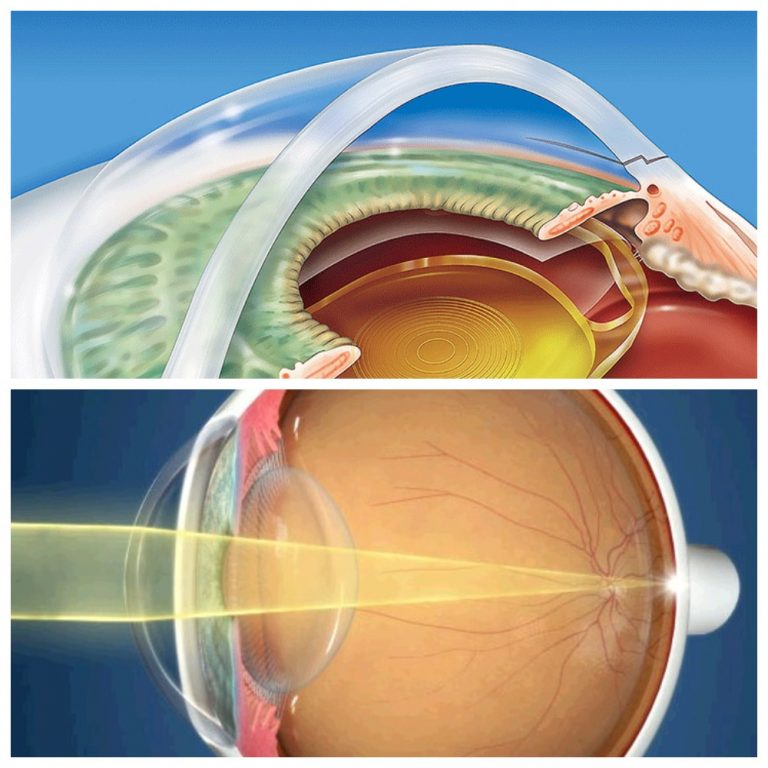 Фото глазного хрусталика
